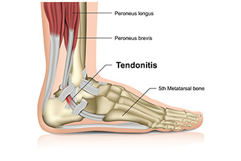 Achilles tendonitis in children