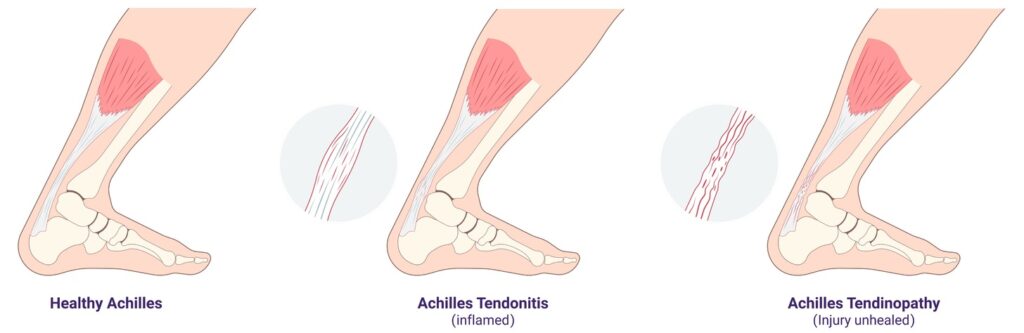Comparison between healthy Achilles tendon and in   v flamed tendon with tendonitis