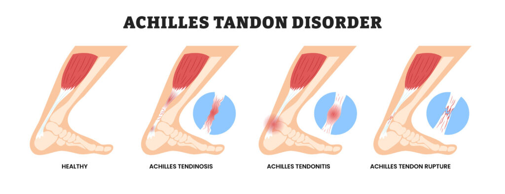 Comparison between healthy Achilles tendon and injured tendon