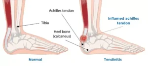 Comparison of a normal Achilles tendon versus an inflamed Achilles tendon