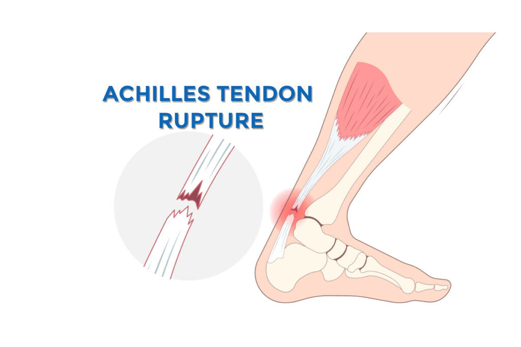 Illustration of Achilles tendon rupture showing complete tear of tendon fibers